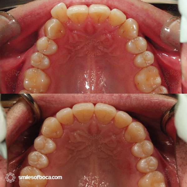 invisalign before and after occlusal upper 030 3