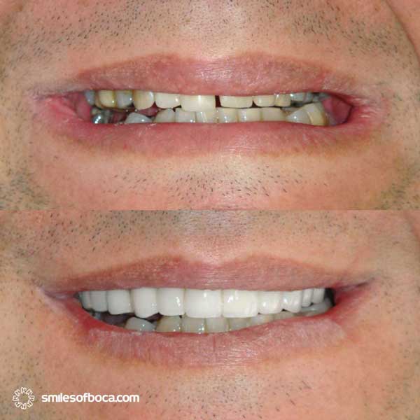 porcelain crowns before and after case 002 1