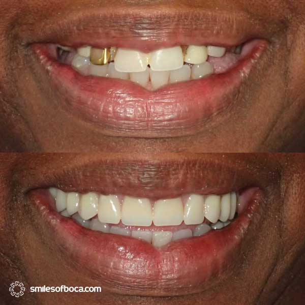 full denture before after 024 1