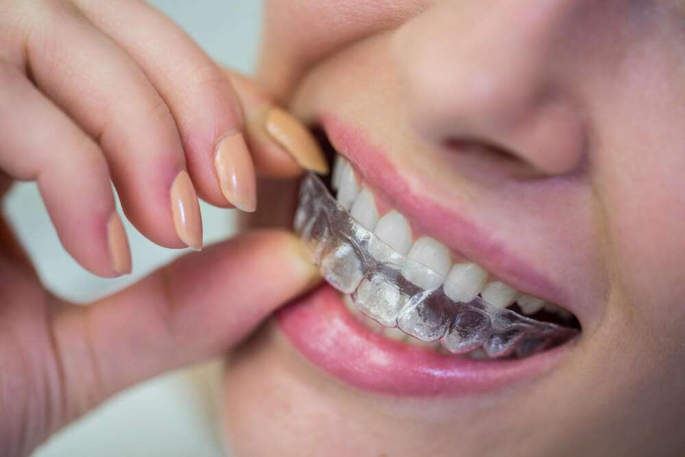  What is invisalign ?