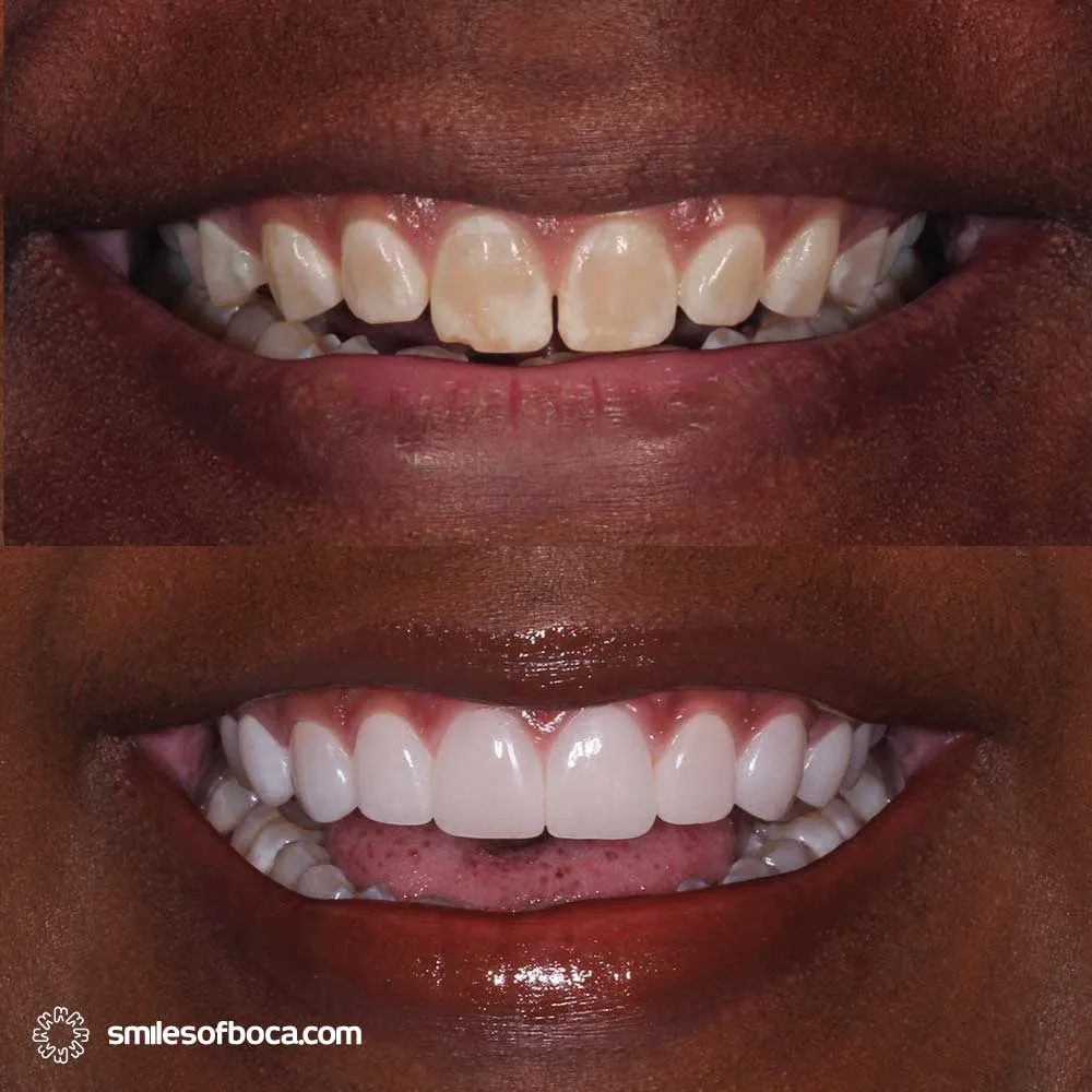 no prep veneers before and after case032