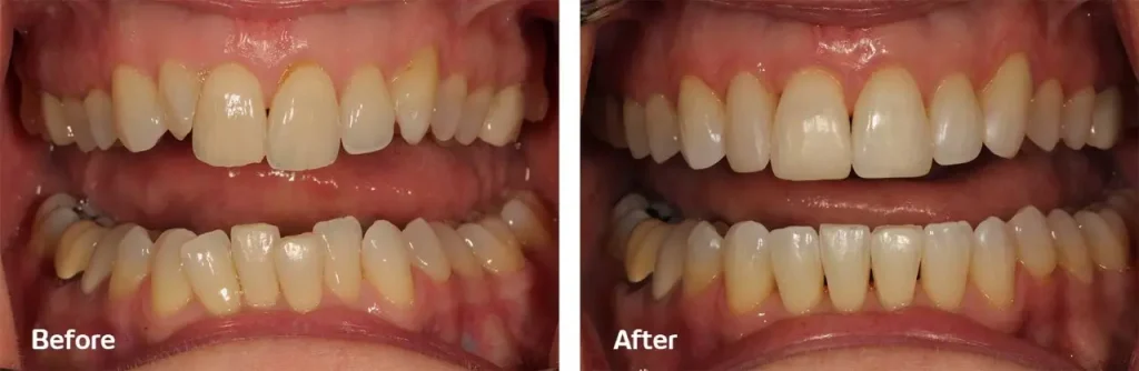 Antes y Después antes y después de los bonding dentales