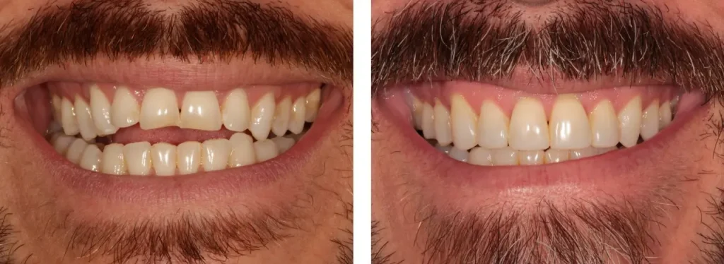 Antes y después Antes y después