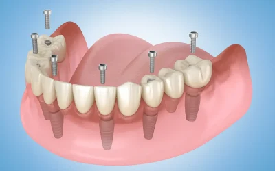 Donde puedo conseguir Todo-en-4 implantes dentales cerca de mí en la Florida?
