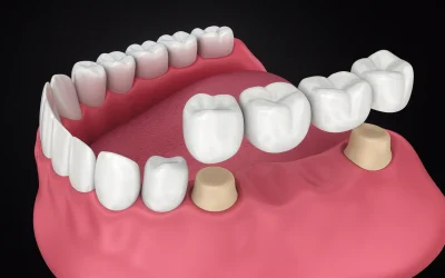 ¿Qué es un Puente Dental? Tipos, Beneficios, y Cuando Usted Puede ser que Necesite Una