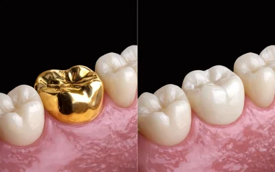 Coronas de oro vs porcelana: Ventajas, desventajas, costo y cuándo funciona mejor cada una