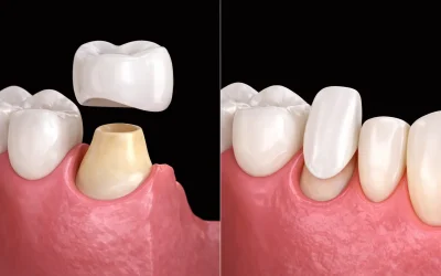 Coronas de porcelana vs carillas: Diferencias clave, beneficios y cuál elegir