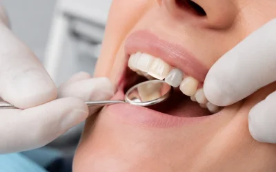 ¿Por qué tu corona dental se ve gris u oscura?: Las 6 causas que los dentistas revisan antes de reemplazarla.