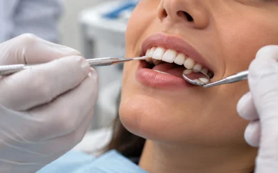 Dental Bonding for a Chipped Tooth: 5 Things to Know Before Repair