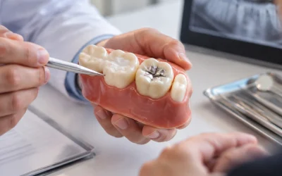 White Fillings vs Silver Fillings: 6 Differences to Discuss With Your Dentist